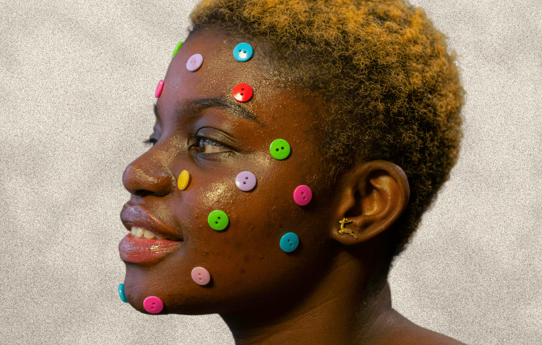 Woman with acne and colorful buttons on her face