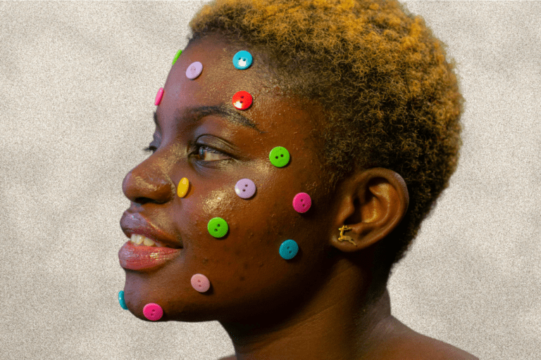 Woman with acne and colorful buttons on her face