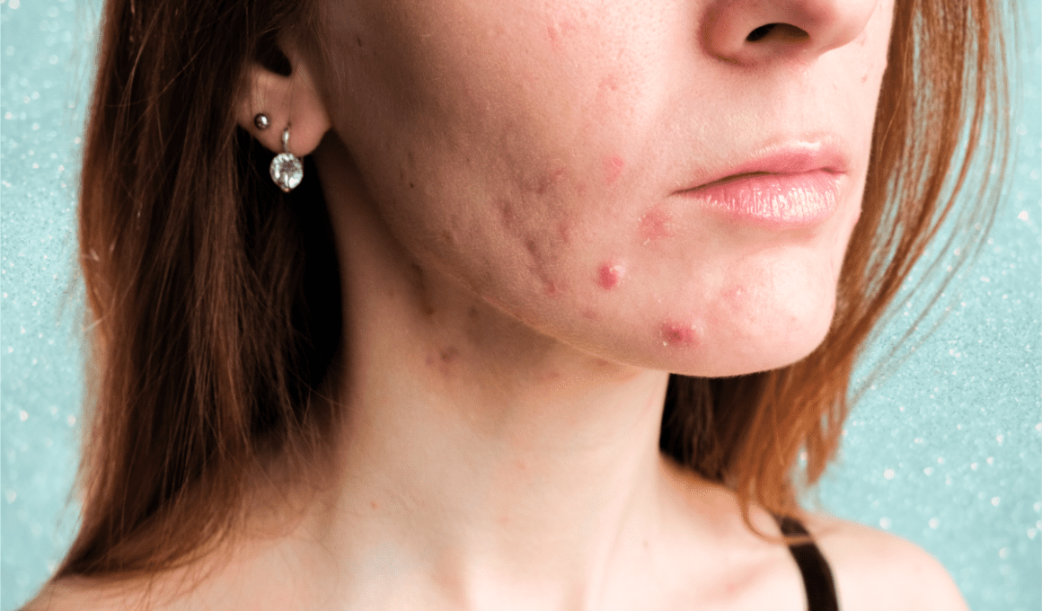 Woman with acne on her jawline