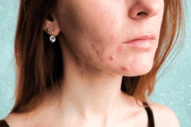 Woman with acne on her jawline