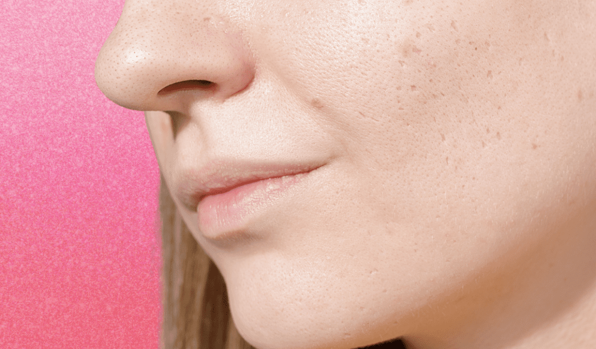 Side of woman's face with indented acne scars