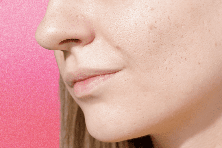 Side of woman's face with indented acne scars