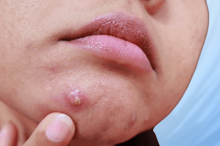 Woman pointing at cyst on chin