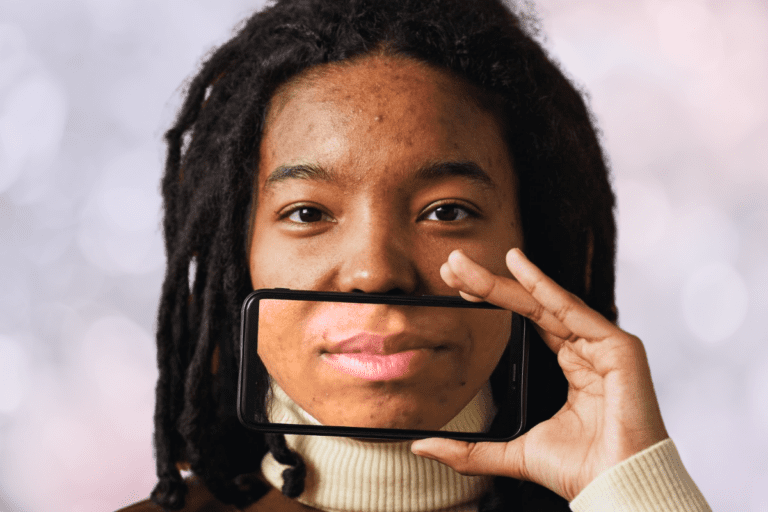 Woman with acne holds up phone in front of her face with an image of her mouth on the screen