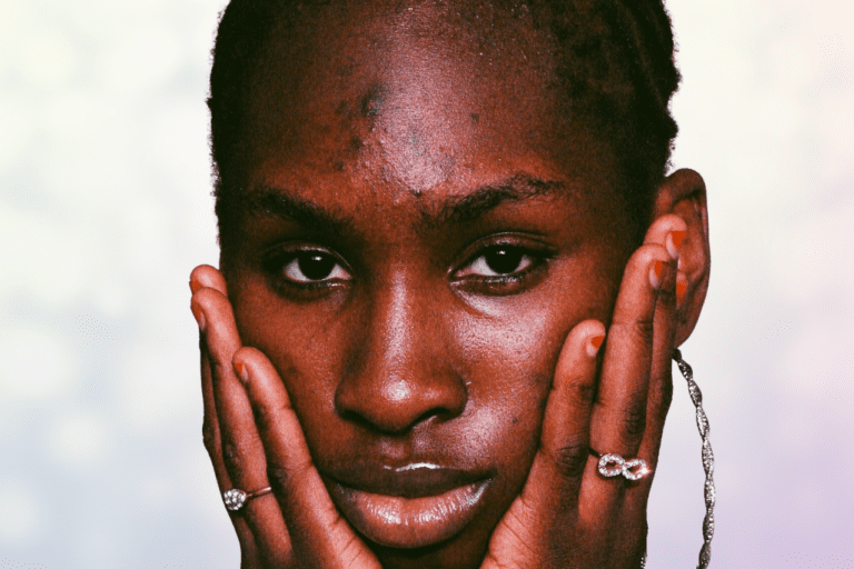 Woman with dark spots of hyperpigmentation on forehead