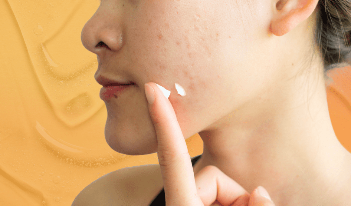 Woman with acne dots a cream onto her face