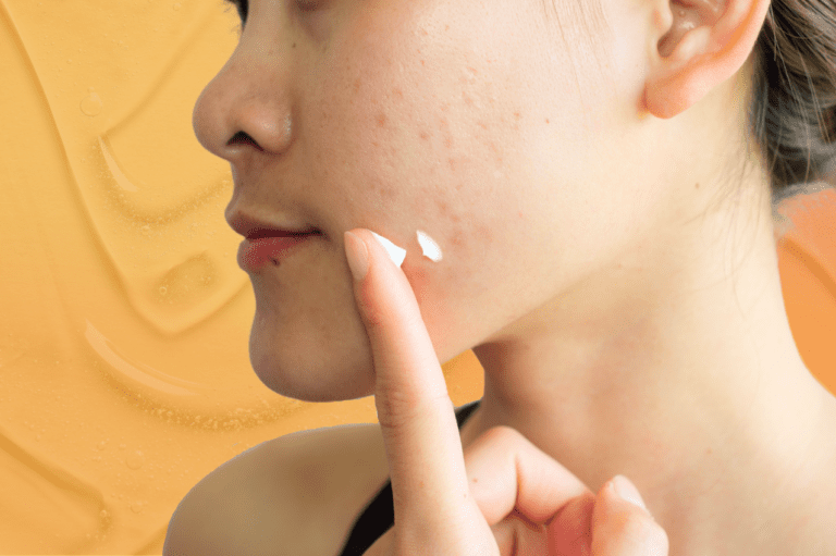 Woman with acne dots a cream onto her face