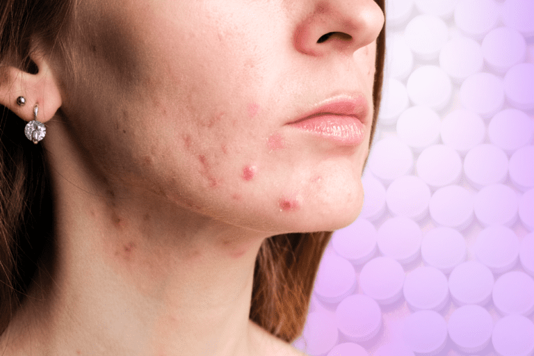 Woman with acne on jawline in front of background of round pills