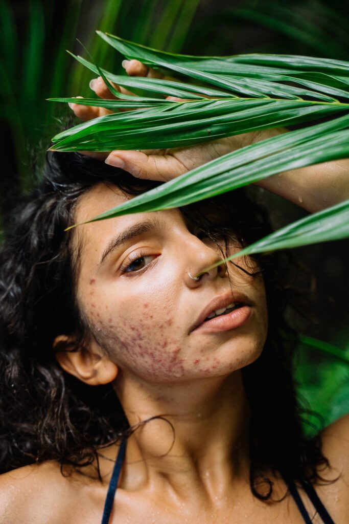 A women with acne on her lower cheeks and jaw looks at the camera from behind a green plant frond