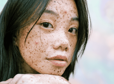 Woman with freckles and a couple of pimples looks at camera