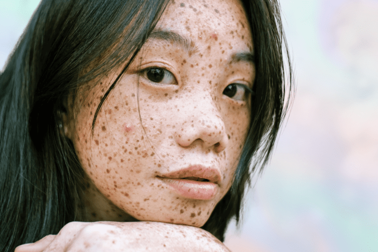 Woman with freckles and a couple of pimples looks at camera