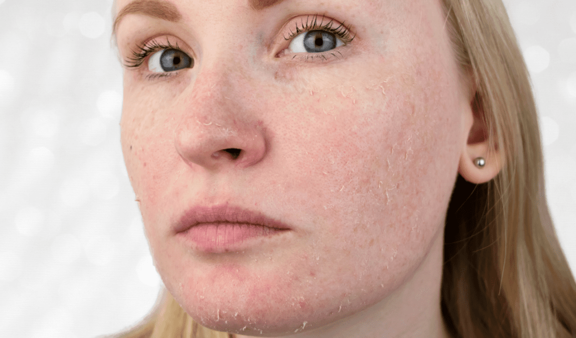 Woman with peeling skin on her face from retinol uglies