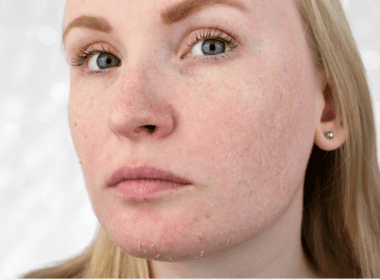 Woman with peeling skin on her face from retinol uglies