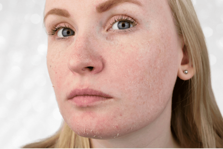 Woman with peeling skin on her face from retinol uglies