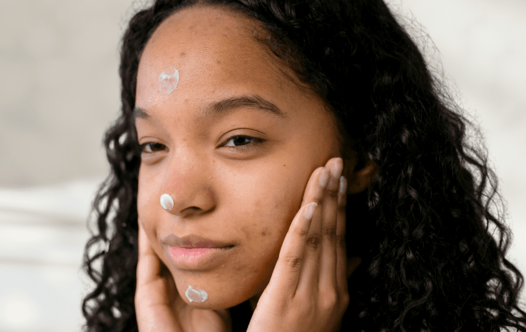 Woman with acne applying face cream