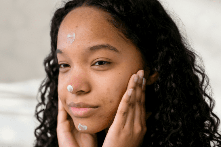 Woman with acne applying face cream