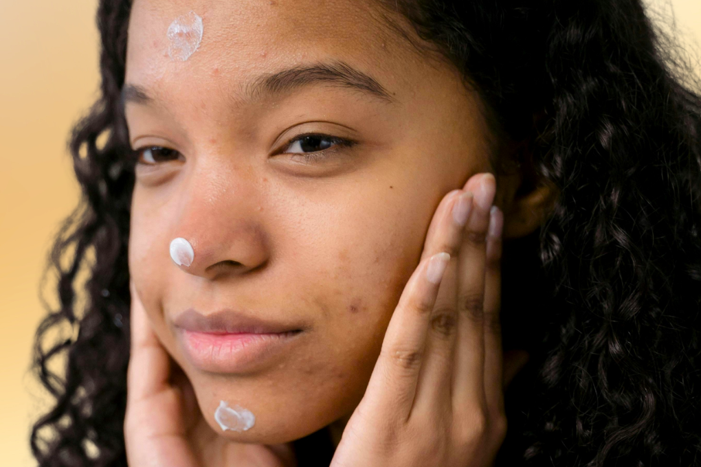 Woman with acne applying face cream