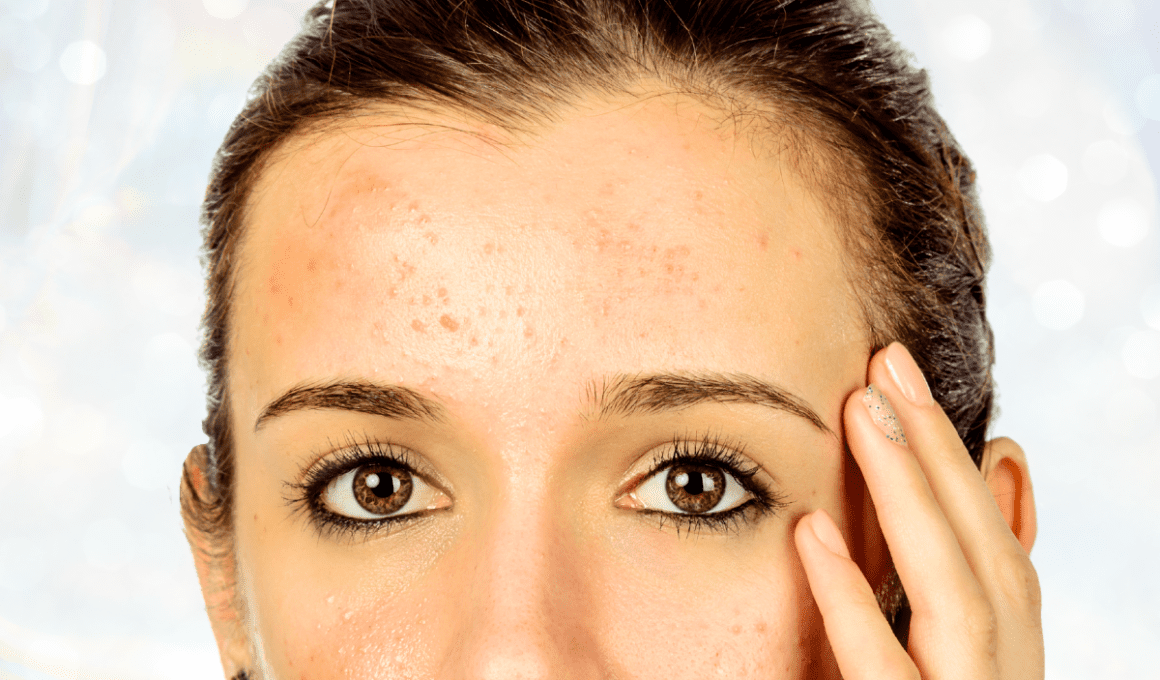 Woman with small pimples on forehead