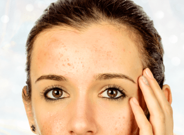 Woman with small pimples on forehead