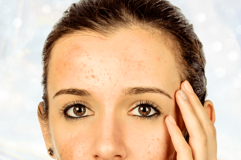 Woman with small pimples on forehead