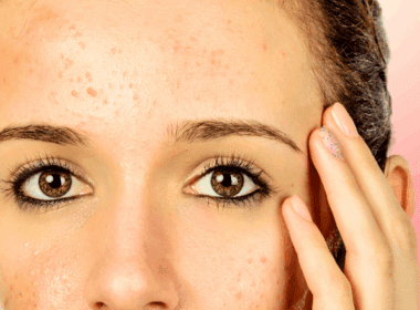 Woman with small pimples on forehead
