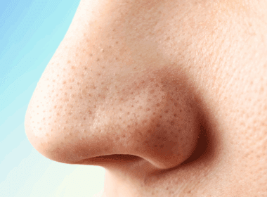 Photo of sebaceous filaments