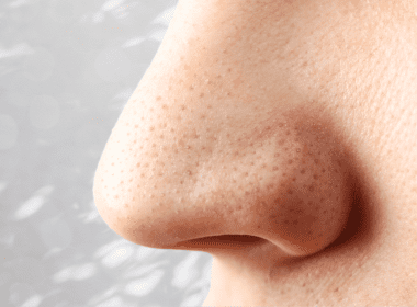 Close view of nose pores with sebaceous filaments