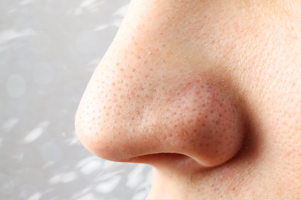 Close view of nose pores with sebaceous filaments