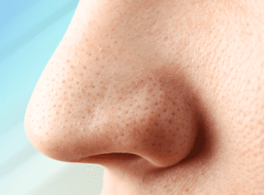 Close view of nose pores with sebaceous filaments