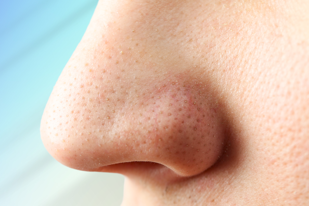 Close view of nose pores with sebaceous filaments