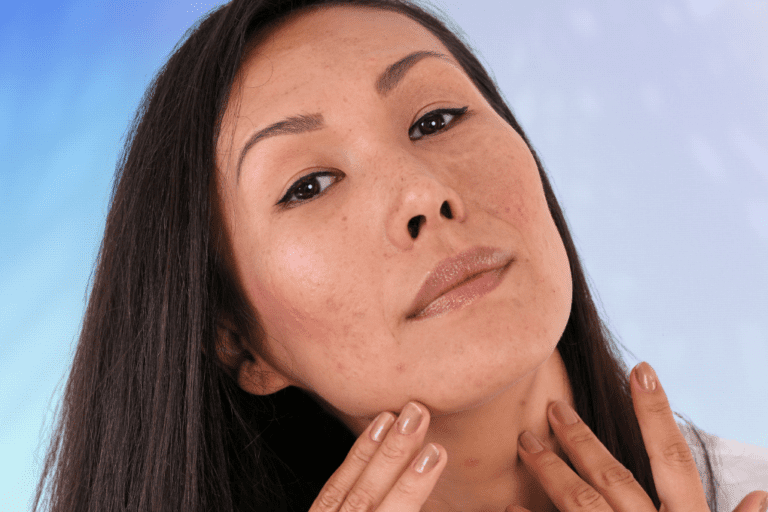 Woman with mild acne touching jawline