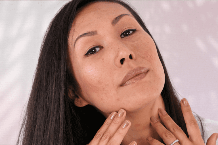 Woman with mild acne touching jawline