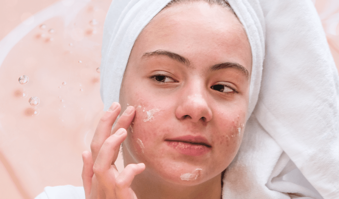 Woman with acne applying face cream