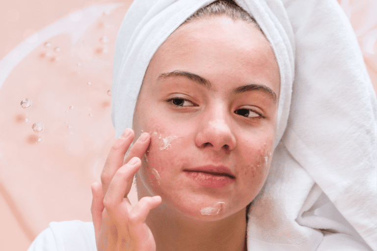 Woman with acne applying face cream