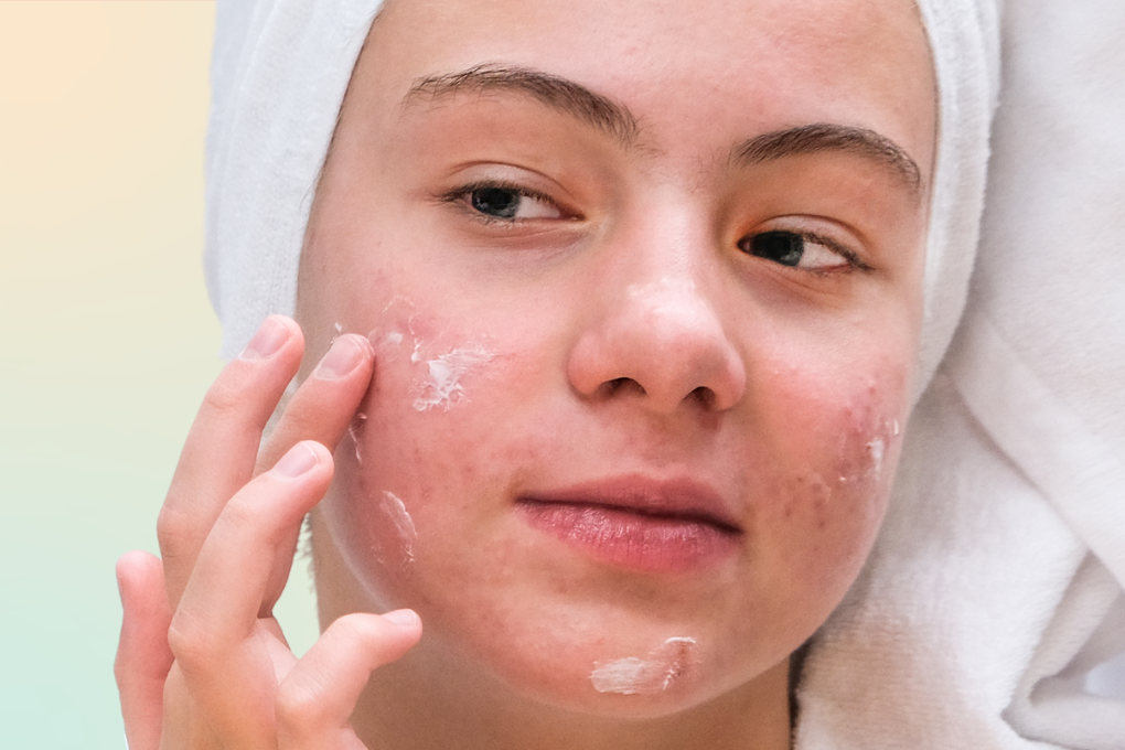 Woman with acne applying moisturizer