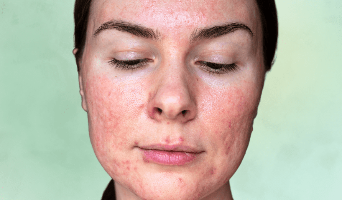 Woman with flushed red skin and pustules from rosacea