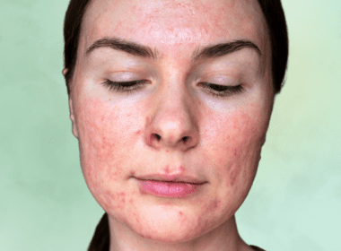 Woman with flushed red skin and pustules from rosacea