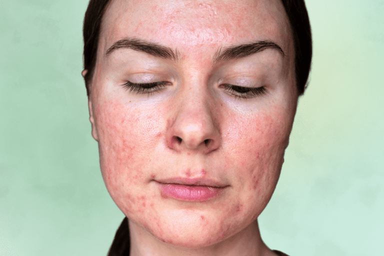 Woman with flushed red skin and pustules from rosacea