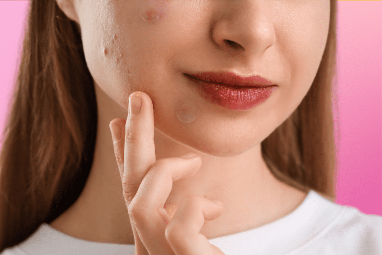 Close up of woman's face with pimple patches over breakouts