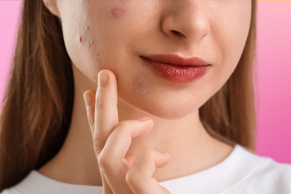 Close up of woman's face with pimple patches over breakouts