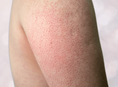 Image of back of arm with small red bumps