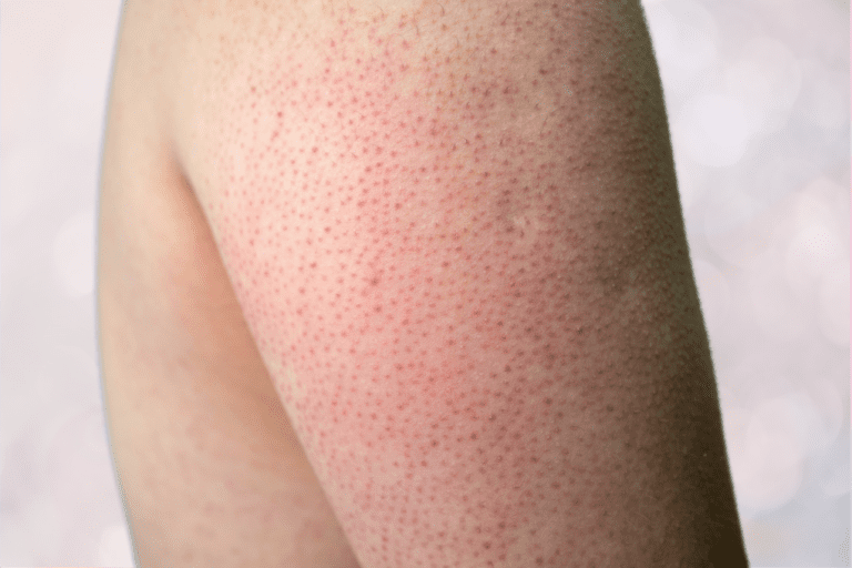 Image of back of arm with small red bumps