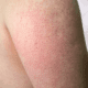 Image of back of arm with small red bumps