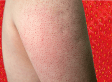Keratosis pilaris arm in front of strawberry background