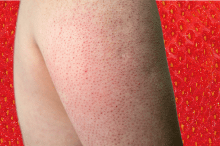 Pimples On The Back Of Arms Heres What You Need To Know About