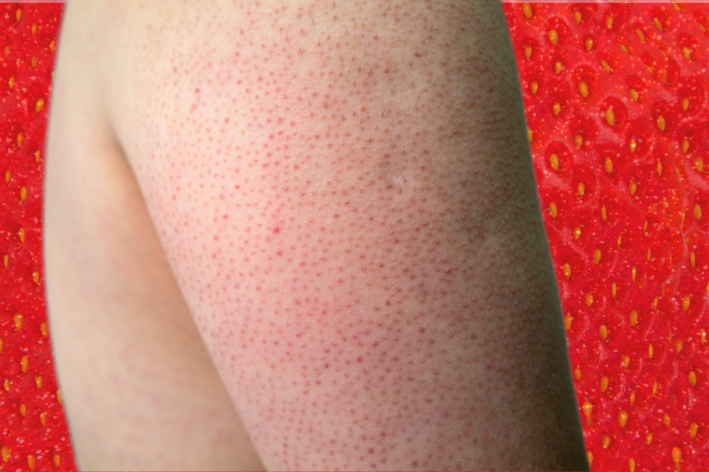 Keratosis pilaris arm in front of strawberry background