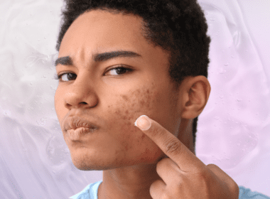 Man with acne about to apply a cream product to face