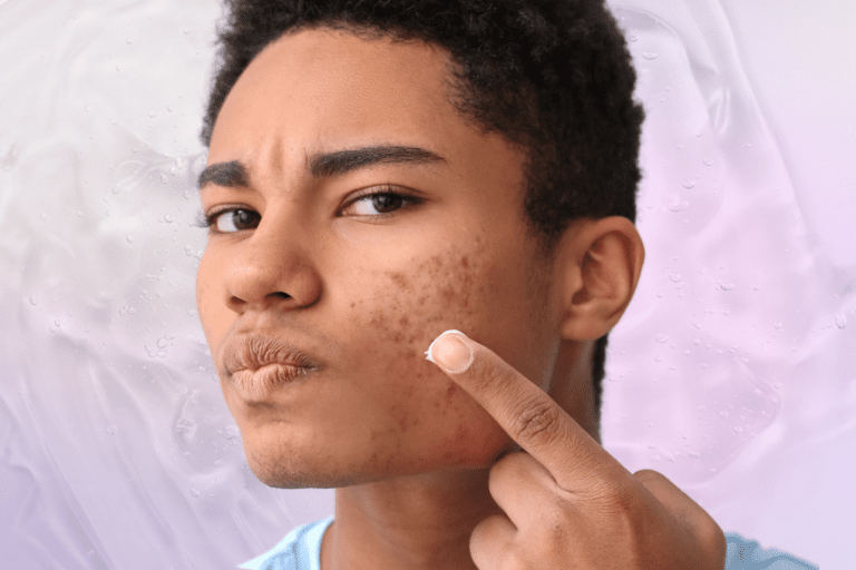 Man with acne about to apply a cream product to face