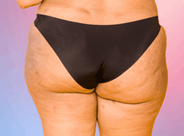 Photo of pimples on butt