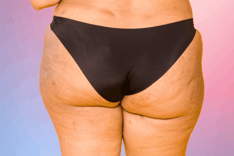 Photo of pimples on butt